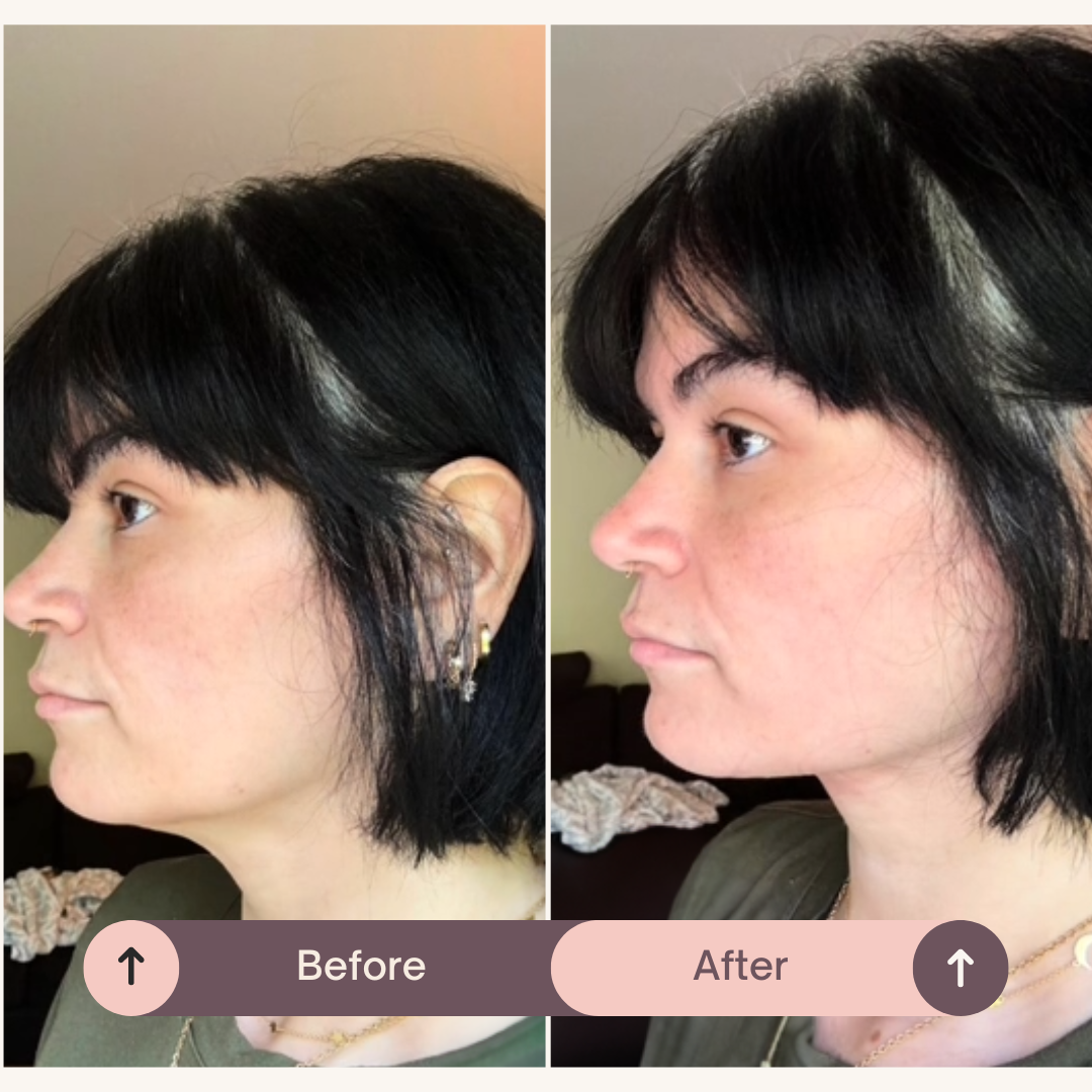 SlipOn™ - Natual V Shape Face Lift Belt