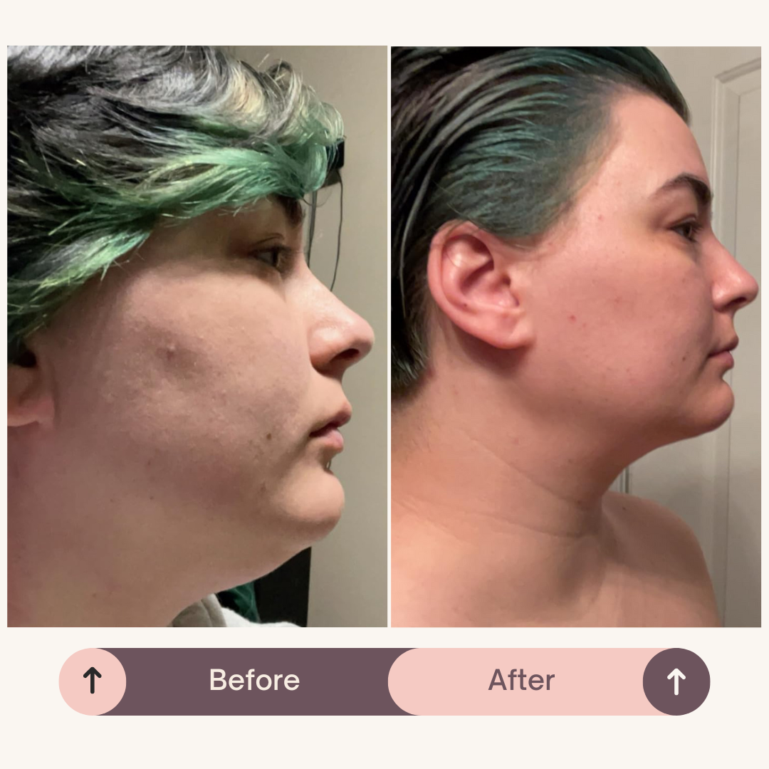 SlipOn™ - Natual V Shape Face Lift Belt