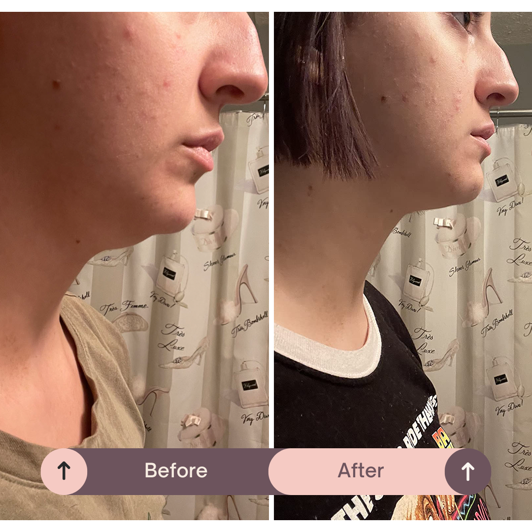 SlipOn™ - Natual V Shape Face Lift Belt